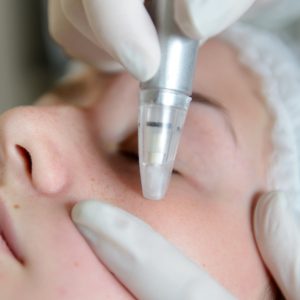 microdermabrasion in Danbury CT